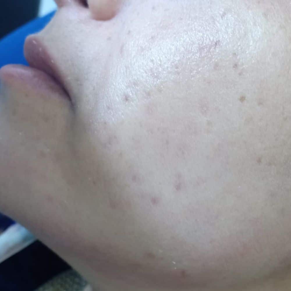 إزالة آثار حب الشباب في مركز نضارة في الغردقة